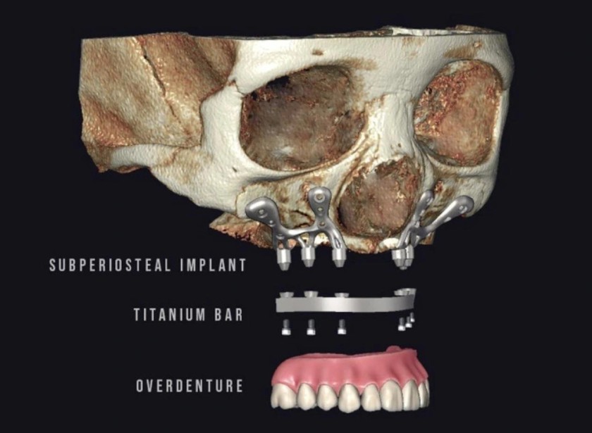 Cấu tạo của Implant cá nhân hóa