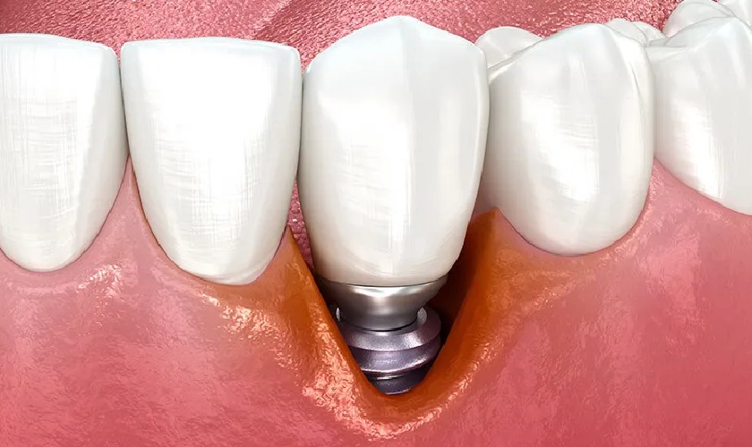 Viêm quanh Implant là tình trạng vô cùng nguy hiểm Viêm quanh Implant là tình trạng vô cùng nguy hiểm