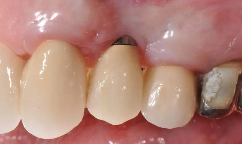 Phương pháp điều trị viêm quanh Implant truyền thống còn nhiều hạn chế Phương pháp điều trị viêm quanh Implant truyền thống còn nhiều hạn chế