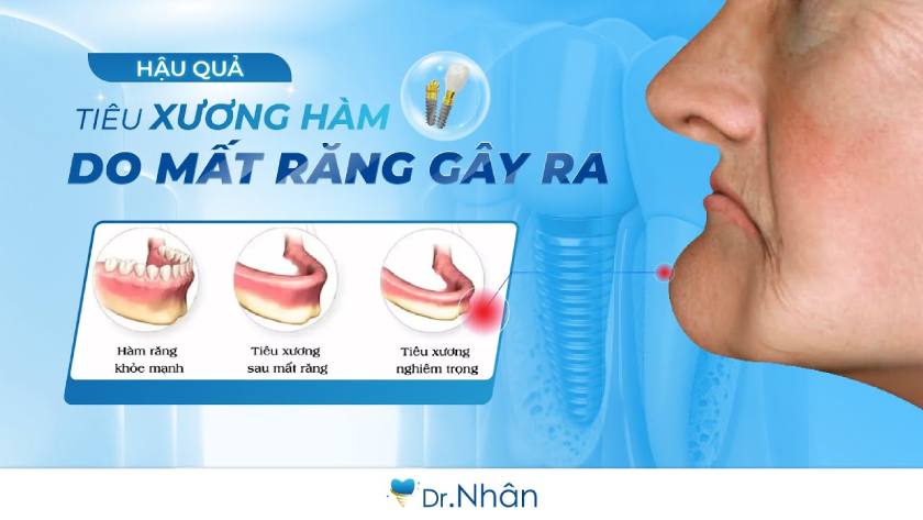 Mất răng hàm dẫn đến tiêu xương và nhiều hệ lụy nghiêm trọng Mất răng hàm dẫn đến tiêu xương và nhiều hệ lụy nghiêm trọng