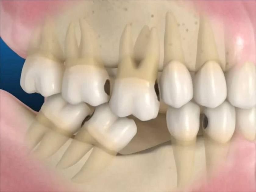 Xô lệch răng do mất răng gây ra Xô lệch răng do mất răng gây ra