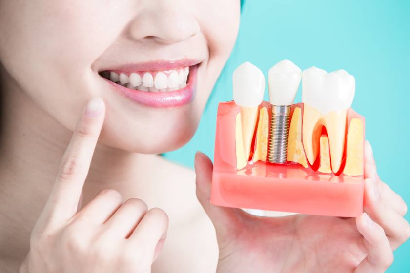 Răng Implant được cấy độc lập vào vị trí mất răng mà không cần mài răng hoặc sử dụng các răng kế cận làm neo đỡ Răng Implant được cấy độc lập vào vị trí mất răng mà không cần mài răng hoặc sử dụng các răng kế cận làm neo đỡ