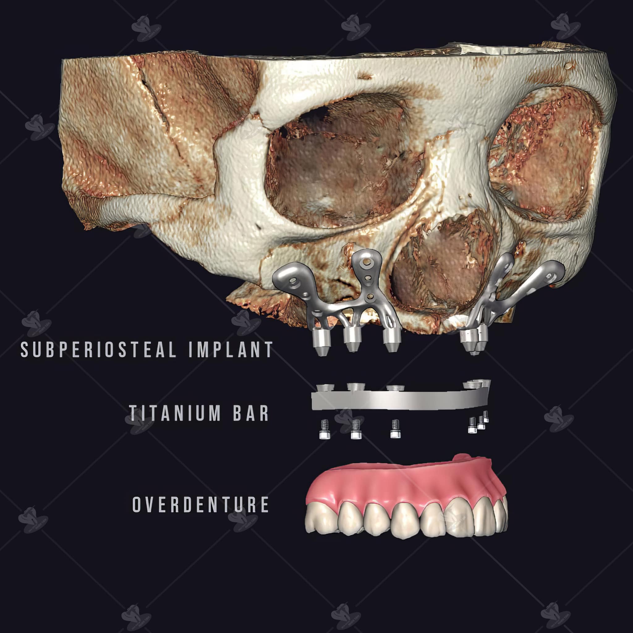 Implant cá nhân hóa được cải tiến từ Implant dưới màng xương Implant cá nhân hóa được cải tiến từ Implant dưới màng xương