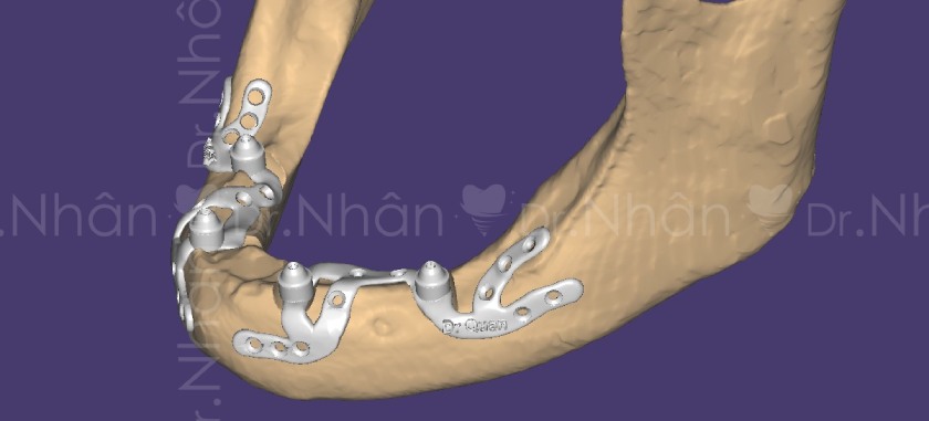 Thiết kế Implant cá nhân hóa Thiết kế Implant cá nhân hóa