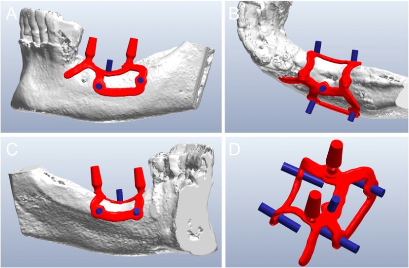 Sự phối hợp chặt chẽ giữa bác sĩ và kỹ thuật viên là rất quan trọng để chế tác Implant cá nhân hóa chính xác Sự phối hợp chặt chẽ giữa bác sĩ và kỹ thuật viên là rất quan trọng để chế tác Implant cá nhân hóa chính xác