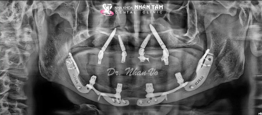 Cấy ghép Implant cá nhân hóa thể hiện qua phim chụp X-quang Cấy ghép Implant cá nhân hóa thể hiện qua phim chụp X-quang