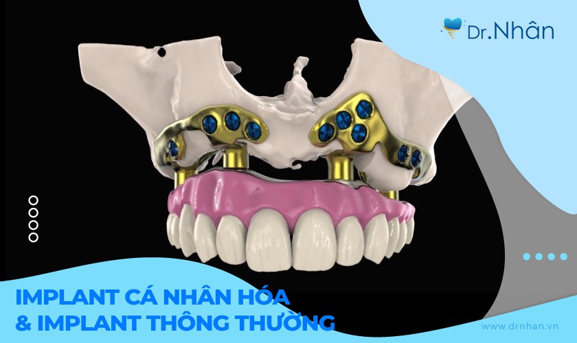 Implant cá nhân hoá có gì khác so với Implant truyền thống?