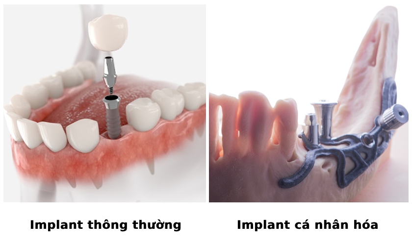 So sánh Implant cá nhân hóa và Implant truyền thống