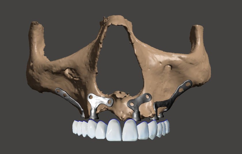 Implant cá nhân hóa có kỹ thuật thực hiện phức tạp