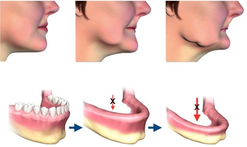 Mất răng và tiêu xương hàm mang đến nhiều hậu quả nặng nề