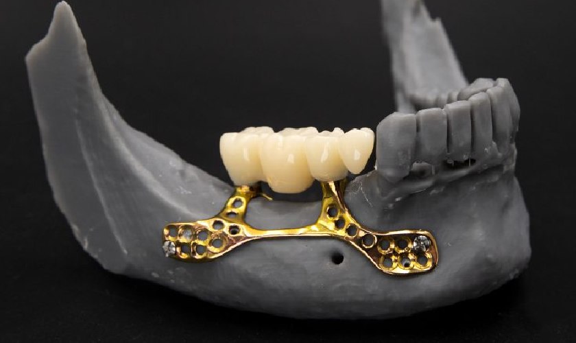 Implant cá nhân hóa là bước đột phá của lĩnh vực Implant tại Việt Nam