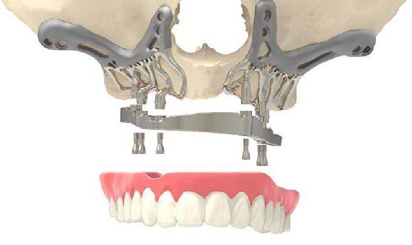 Implant cá nhân hóa mang lại nhiều lợi ích cho cả bác sĩ và bệnh nhân