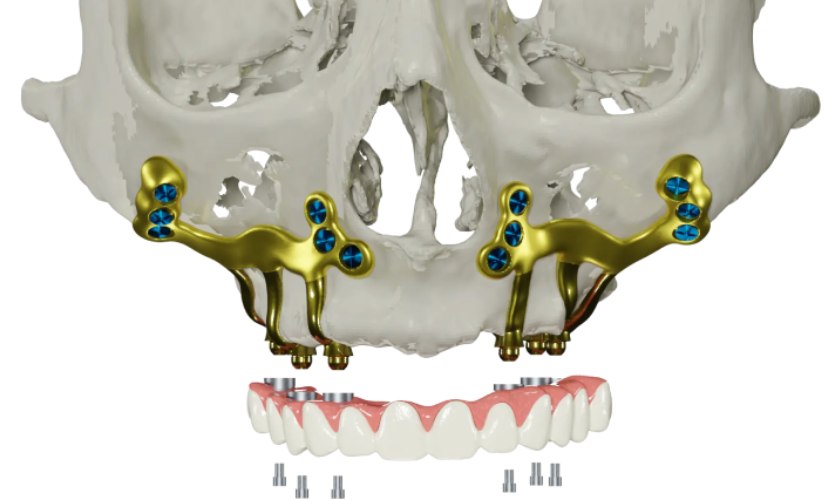 Implant cá nhân hóa được cải tiến từ Implant dưới màng xương