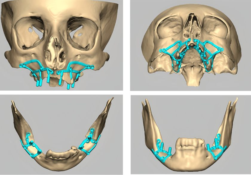 Implant cá nhân hóa - “Cứu cánh” cho những trường hợp phức tạp