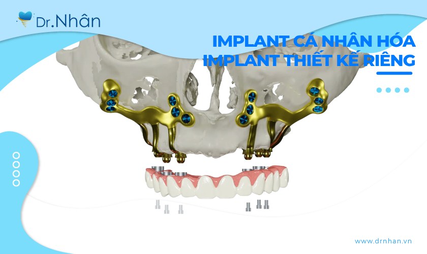 Implant thiết kế riêng: Giải pháp tối ưu cho từng bệnh nhân