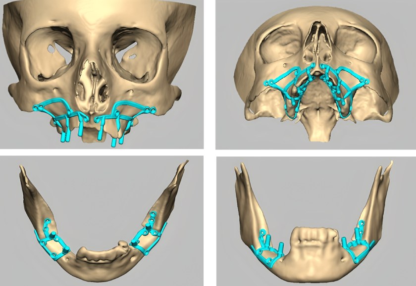 Implant thiết kế riêng cho từng trường hợp bệnh nhân