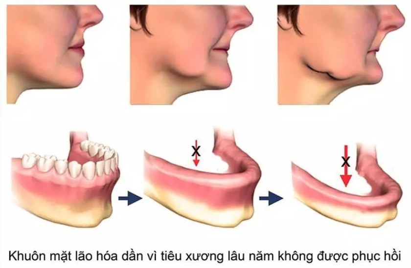 Tiêu xương hàm nghiêm trọng do mất răng lâu ngày