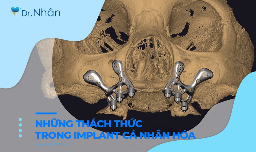 Những thách thức trong kỹ thuật Implant cá nhân hóa