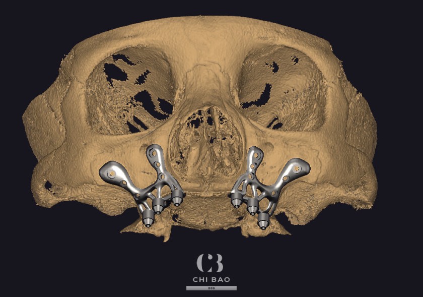 Cấy ghép Implant dưới màng xương không sử dụng trụ Implant cắm vào xương hàm như kỹ thuật Implant thông thường mà sử dụng bộ cấy ghép riêng biệt đặt vào vị trí dưới màng xương