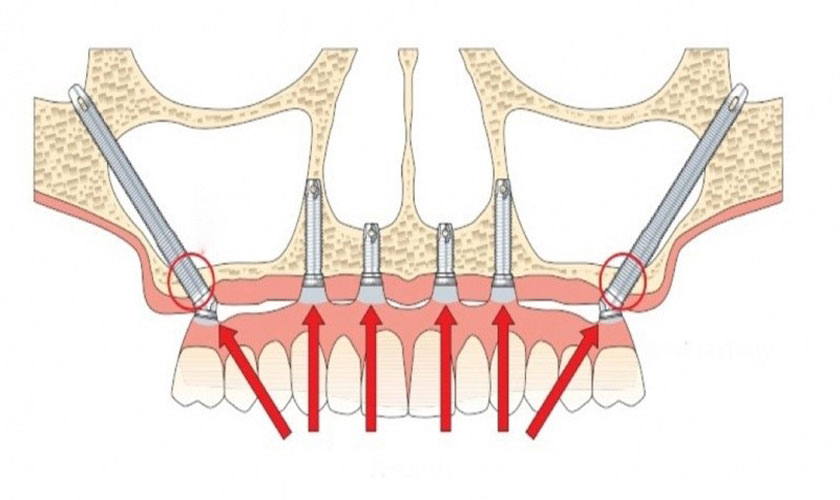 Implant xương gò má sử dụng trụ Implant có kích thước dài để cấy vào vùng xương gò má theo góc nghiêng