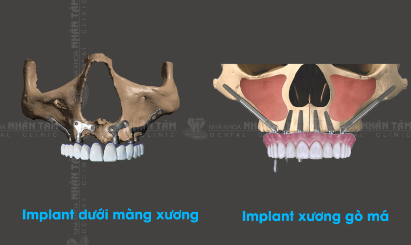 Implant dưới màng xương và Implant xương gò má khác biệt về vị trí đặt Implant