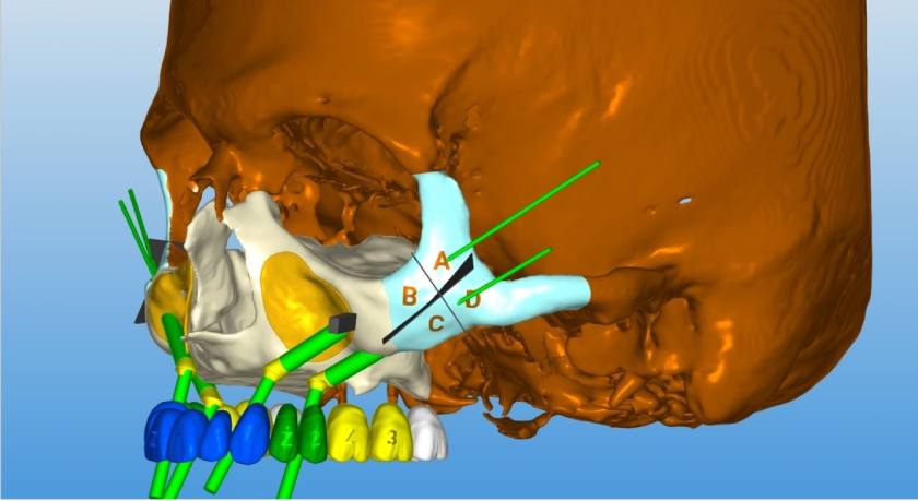 Implant xương gò má không có khung kim loại như Implant dưới màng xương, thiết kế Implant thon dài (gấp 2-3 lần trụ thông thường)