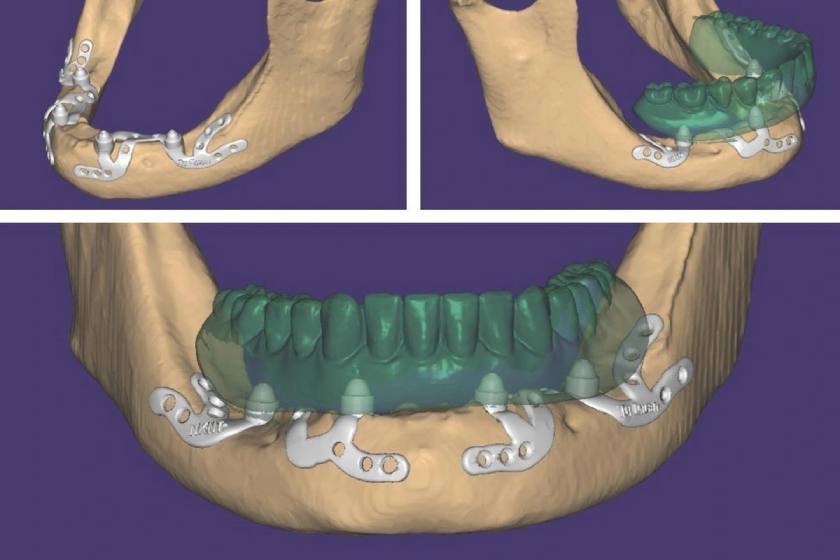 Implant dưới màng xương dựa vào mô nướu xung quanh với phần xương hàm còn lại để nâng đỡ trụ Implant