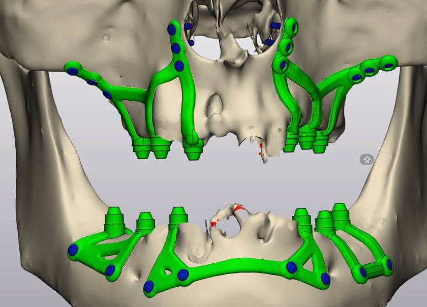 Implant dưới màng xương và Implant xương gò má là hai kỹ thuật Implant phức tạp, đòi hỏi yêu cầu cao về Bác sĩ và công nghệ ứng dụng