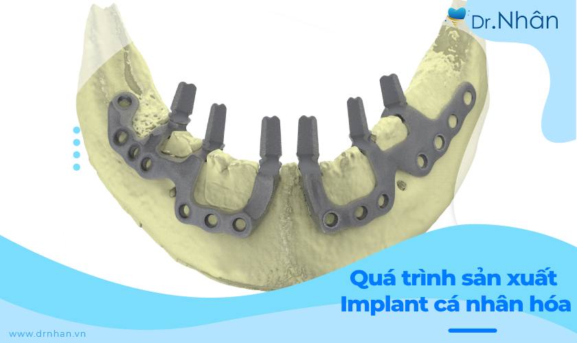 Quá trình sản xuất Implant cá nhân hóa diễn ra như thế nào?