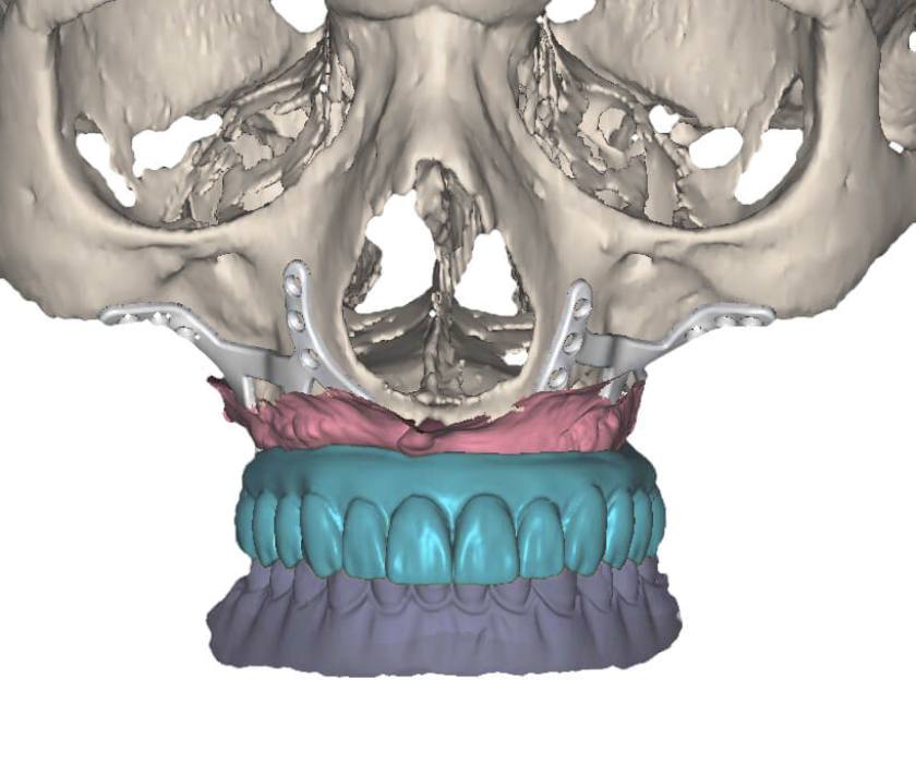 Sự ra đời của kỹ thuật Implant cá nhân hóa mang tính cách mạng cho lĩnh vực Implant nha khoa