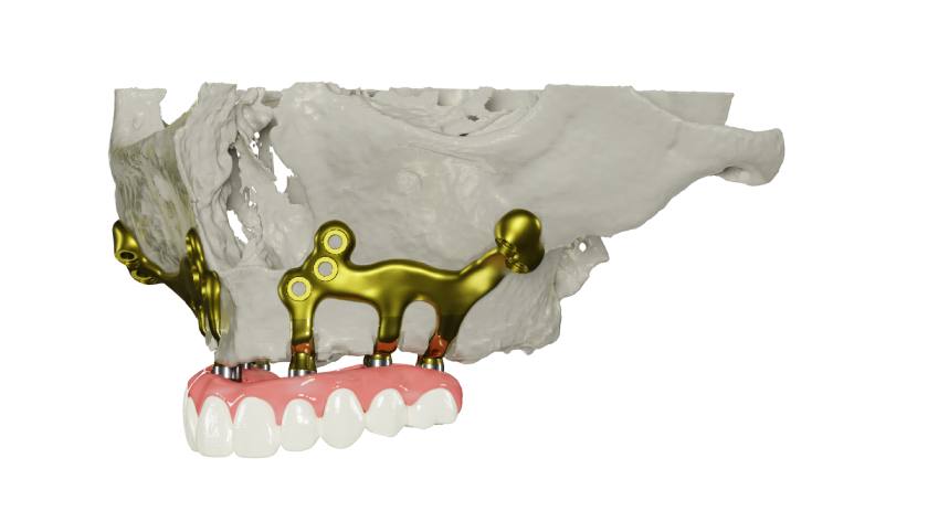 Nhờ ứng dụng công nghệ hiện đại kết hợp chuyên môn và kinh nghiệm của Bác sĩ, Implant cá nhân hóa có tỷ lệ thành công cao