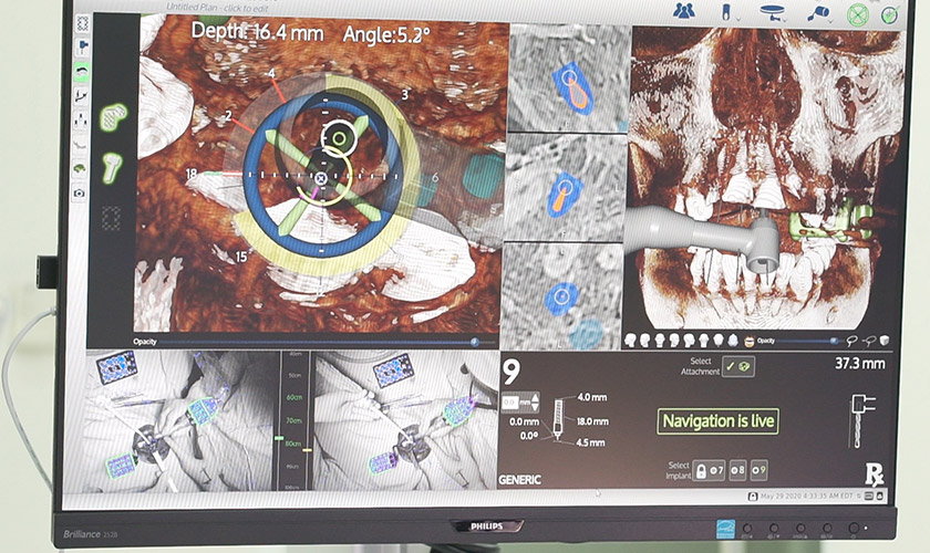 Công nghệ định vị cho thấy hoạt động của mũi khoan trong xương hàm