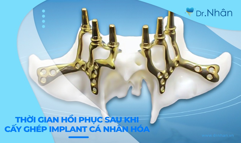 Thời gian hồi phục sau khi cấy ghép implant cá nhân hóa