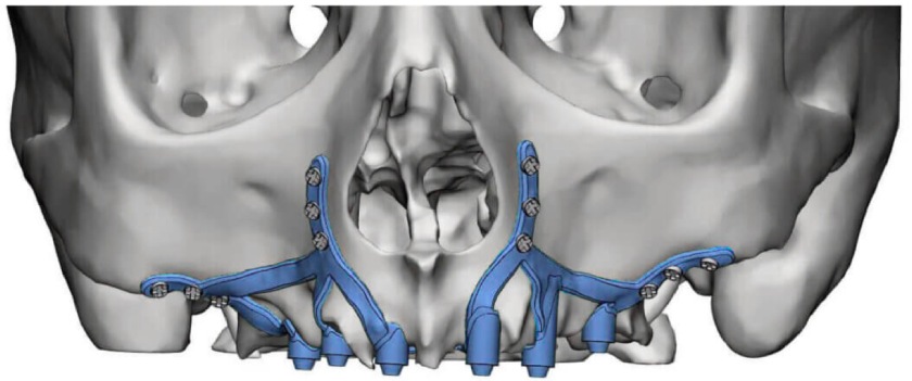 Thời gian hồi phục sau khi cấy ghép implant cá nhân hóa tùy thuộc vào mỗi cá nhân