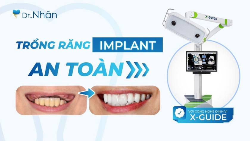 Trồng răng Implant an toàn bằng công nghệ định vị X-Guide tại Nha khoa Nhân Tâm Trồng răng Implant an toàn bằng công nghệ định vị X-Guide tại Nha khoa Nhân Tâm