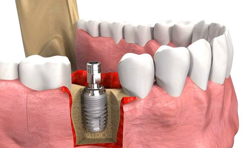 Trồng răng Implant là giải pháp phục hình răng hiện đại, khắc phục được những nhược điểm của các kỹ thuật hàm giả tháo lắp hay cầu răng sứ Trồng răng Implant là giải pháp phục hình răng hiện đại, khắc phục được những nhược điểm của các kỹ thuật hàm giả tháo lắp hay cầu răng sứ
