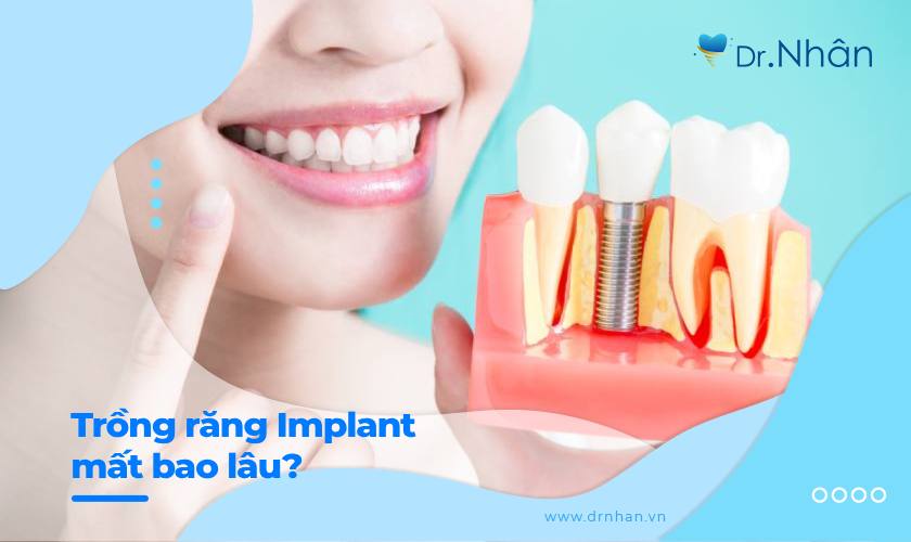 Trồng răng Implant mất bao lâu thì hoàn thành?