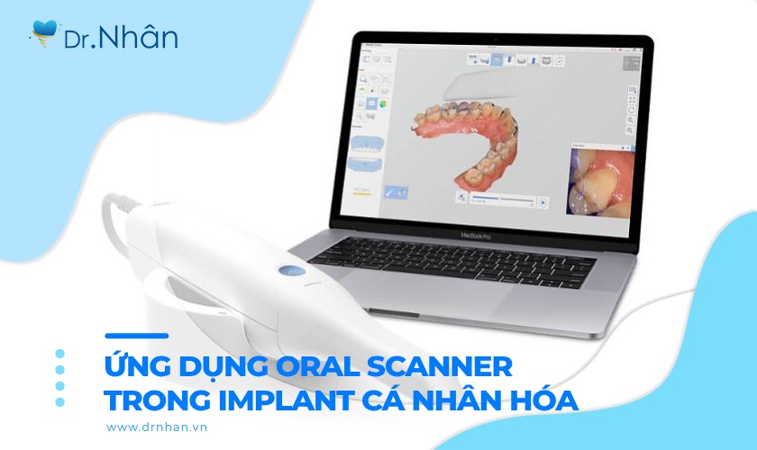 Ứng dụng Oral Scanner trong cấy ghép Implant cá nhân hóa