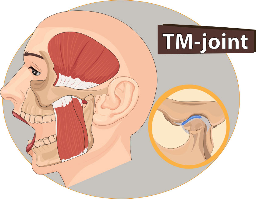 Khớp thái dương hàm (TMJ) là khớp nối giữa xương hàm dưới với hộp sọ