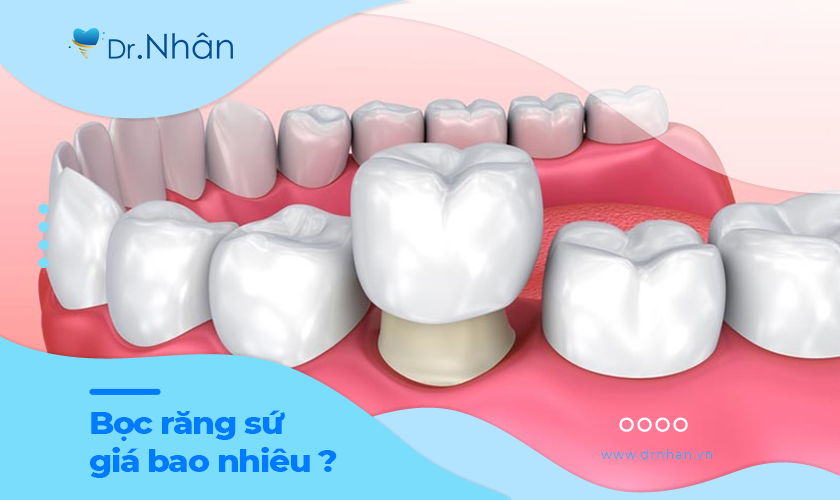 Bọc răng sứ có giá bao nhiêu tiền?