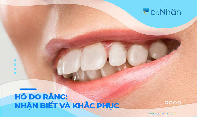 Hô do răng: Cách nhận biết và giải pháp khắc phục