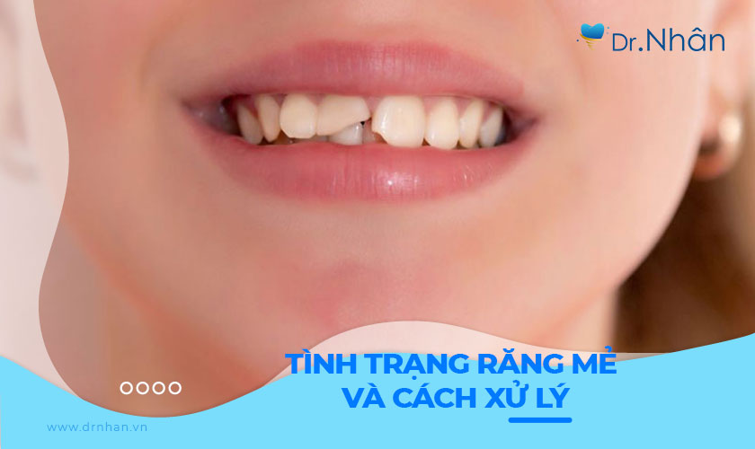 Mẻ răng phải làm sao? Cách xử lý răng mẻ, vỡ