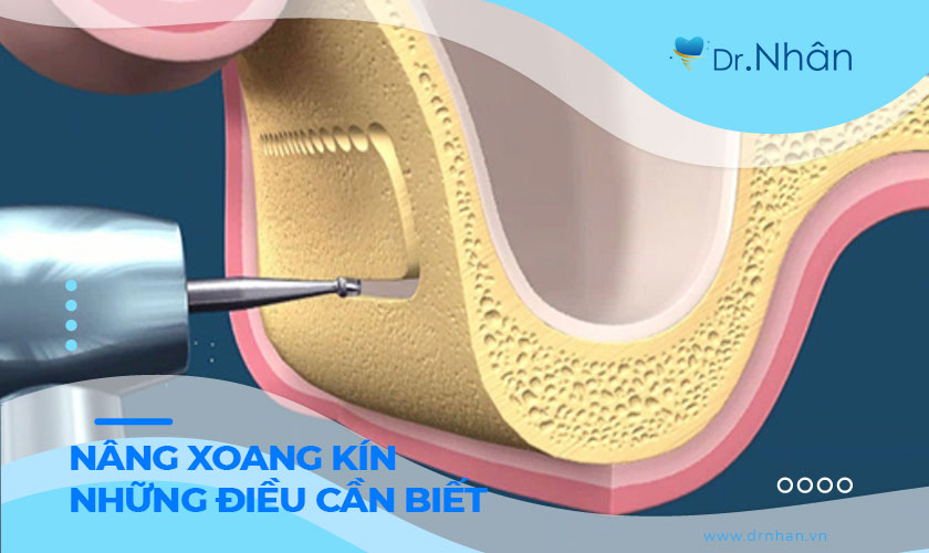 Nâng xoang kín và những điều cần biết