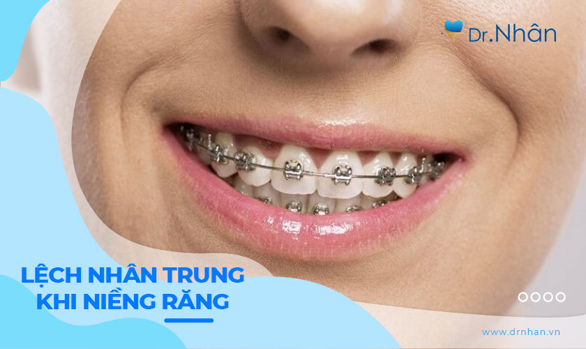 Nhân trung bị lệch khi niềng răng cần phải làm gì?