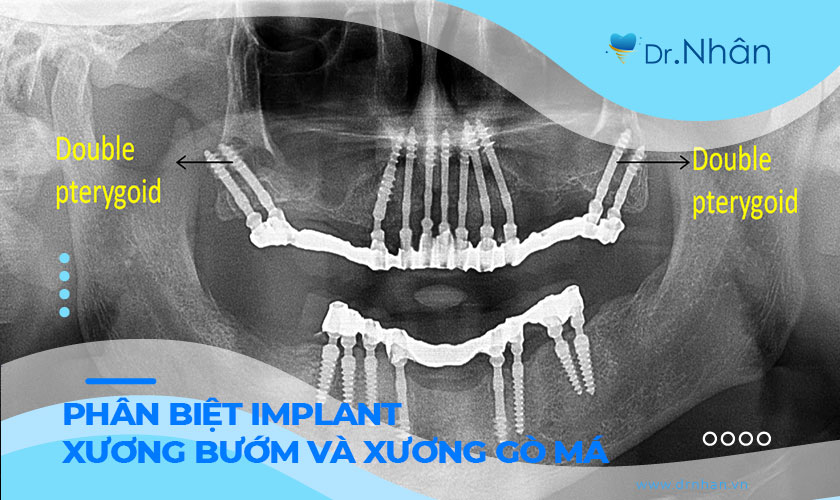 Phân biệt kỹ thuật Implant xương bướm và Implant xương gò má