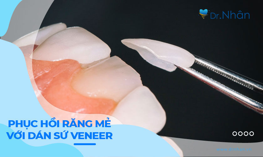 Phục hồi răng cửa mẻ với giải pháp dán sứ Veneer