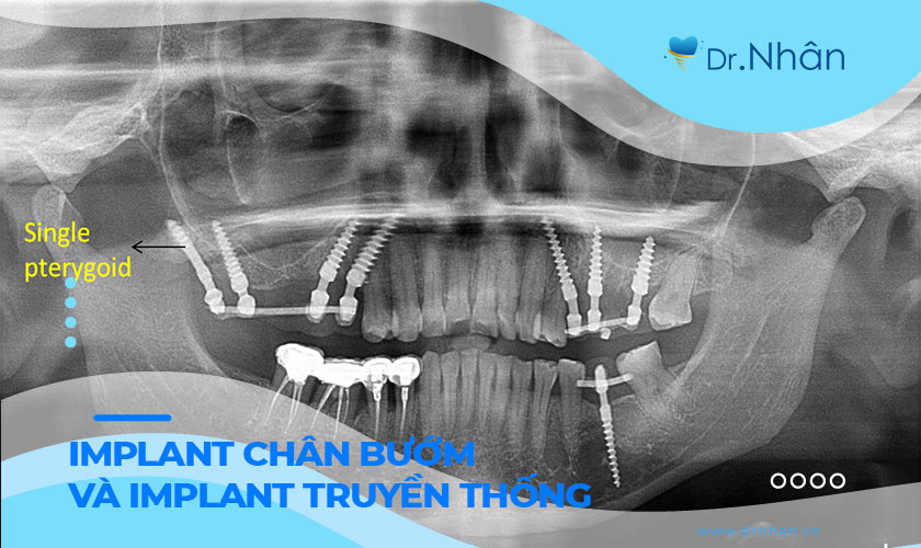 So sánh phương pháp Implant chân bướm và Implant truyền thống