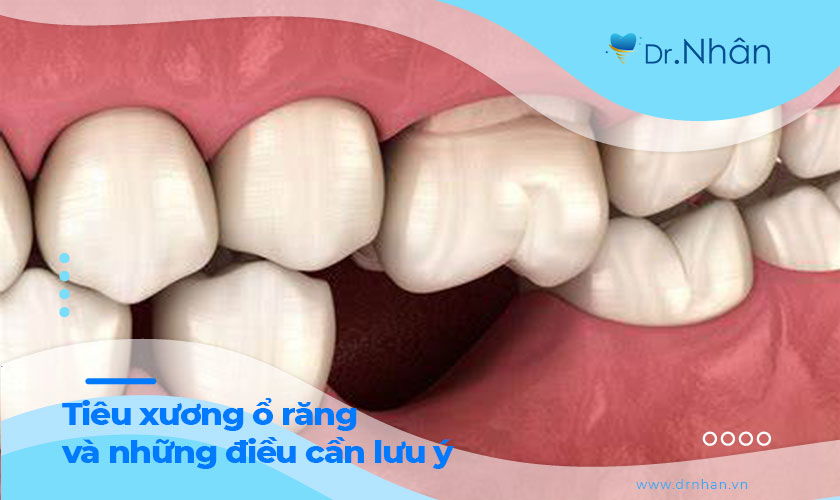 Tiêu xương ổ răng và những điều cần lưu ý