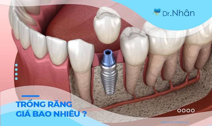 Trồng răng implant giá bao nhiêu?