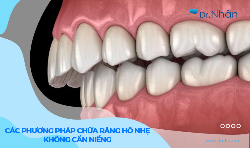 Chữa răng hô nhẹ không cần niềng có được không?